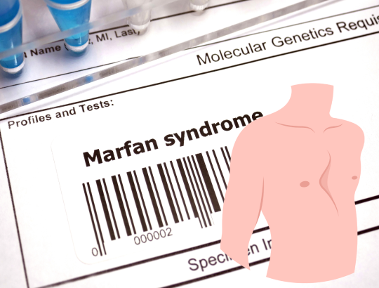Синдром Марфана: редкое генетическое заболевание, требующее внимания нескольких специалистов